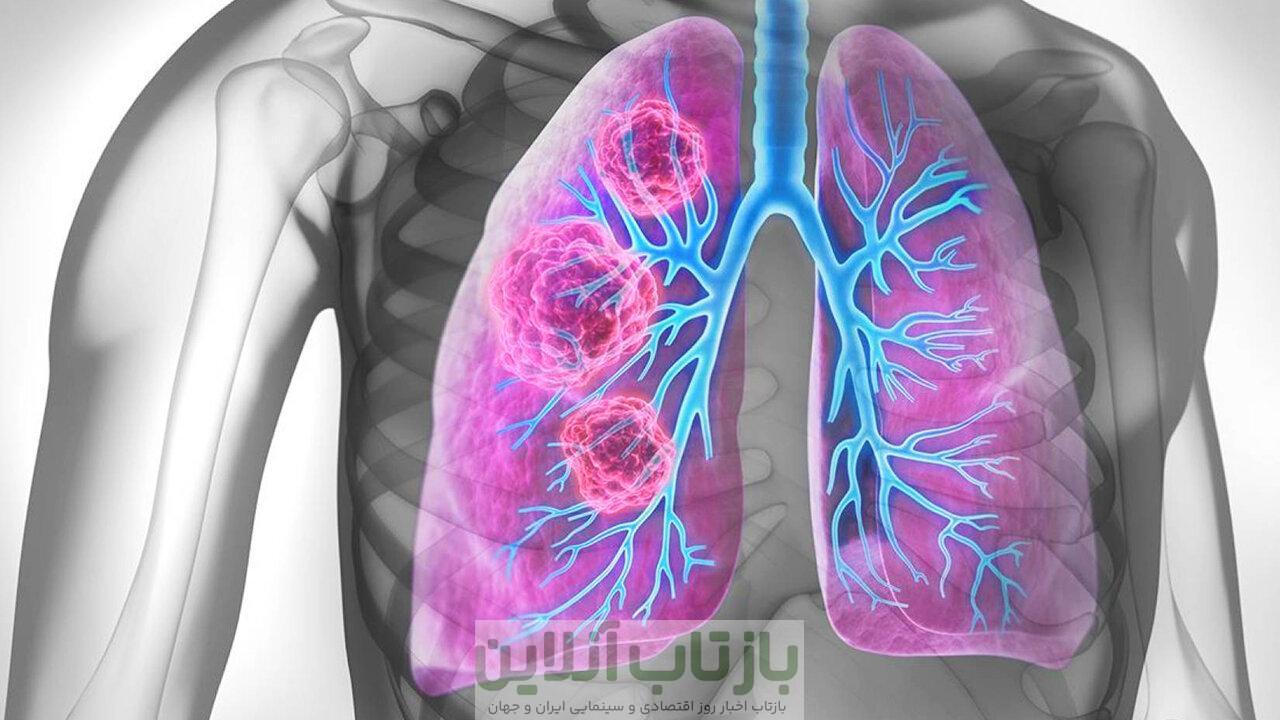 از هر ۵ بیمار مبتلا به سرطان ریه، یک نفر غیرسیگاری است